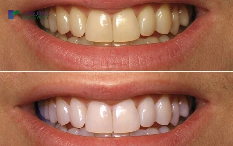 Giải đáp: Tẩy trắng răng có bị vàng lại không?
