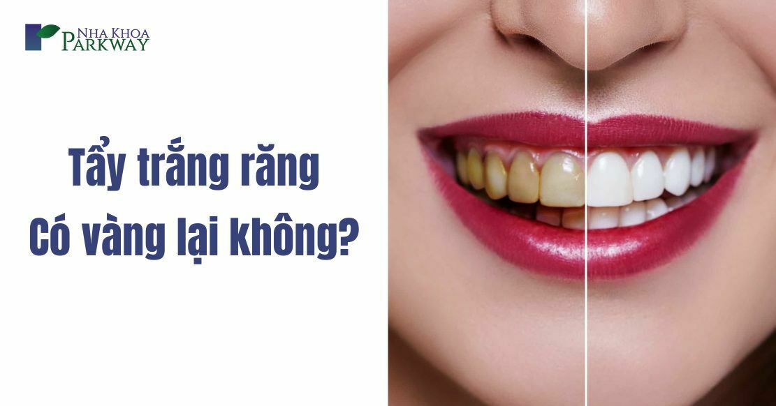 Giải đáp: Tẩy trắng răng có bị vàng lại không?
