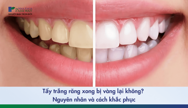 Tẩy trắng răng xong bị vàng lại​ không? Nguyên nhân và cách khắc phục