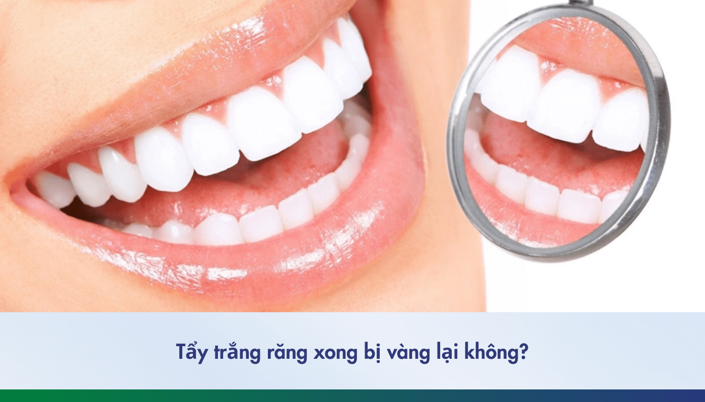 tẩy trắng răng xong bị vàng lại