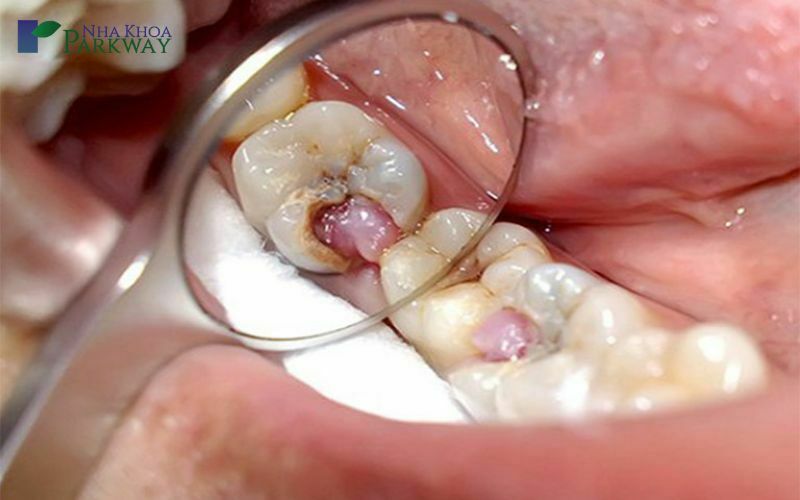 Viêm tủy răng ở trẻ là như thế nào?