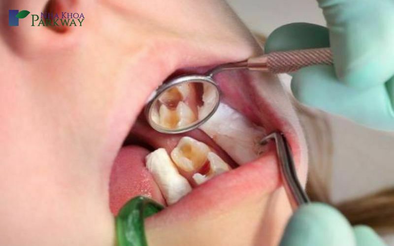 Viêm tủy răng sữa không thể phục hồi