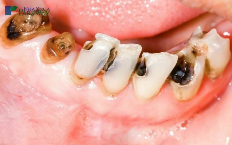 Do sâu răng không được điều trị sớm
