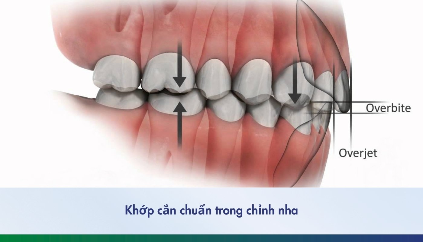 Khớp cắn chuẩn là gì? Làm sao để có hàm răng chuẩn khớp cắn?