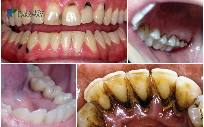 Cao đen răng là gì?