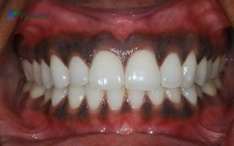 Nướu răng bị đen là gì?