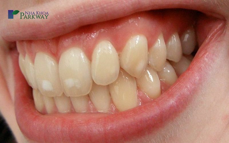 Ảnh hưởng của răng đen ở kẽ