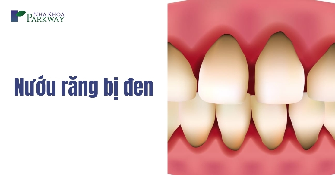 Tại sao nướu răng bị đen? 5 Cách khắc phục nướu răng bị đen