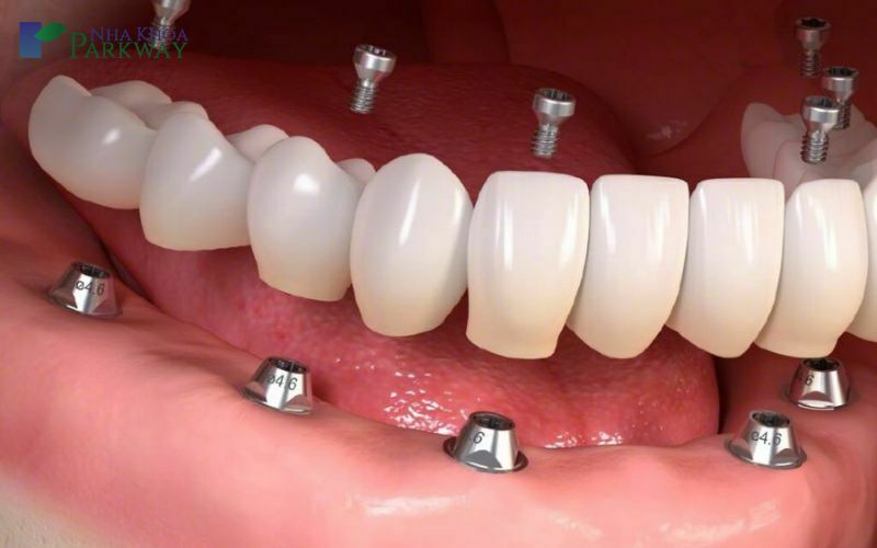 Trồng răng implant nguyên hàm loại nào tốt nhất hiện nay?