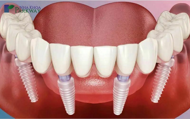 Chi phí trồng răng implant nguyên hàm có đắt không?