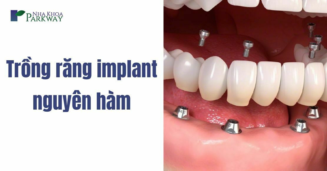 Trồng răng implant nguyên hàm giá bao nhiêu?