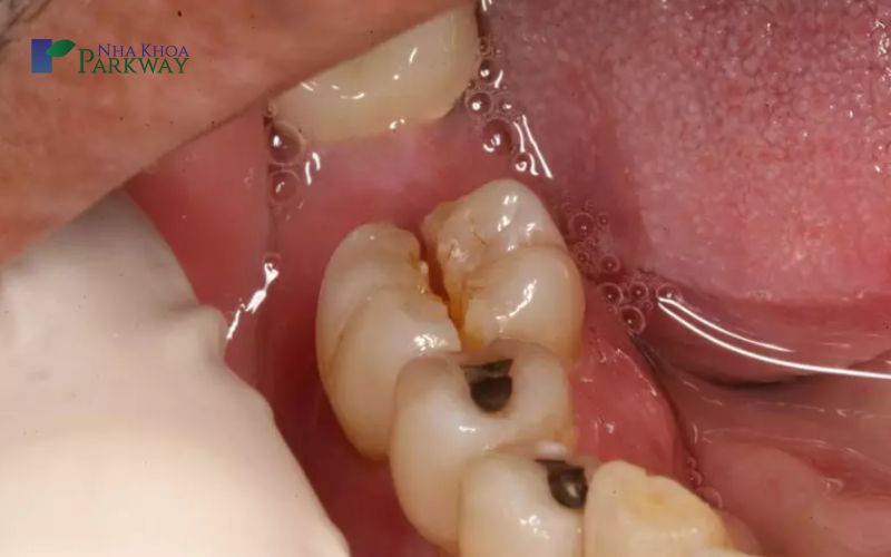Bị mẻ răng hàm có sao không? Răng hàm bị mẻ phải làm sao?