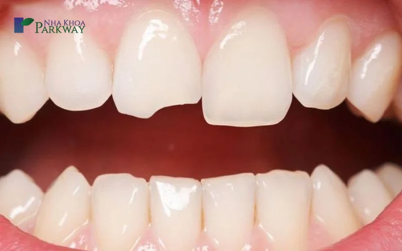 Răng mẻ có hồi phục được không?