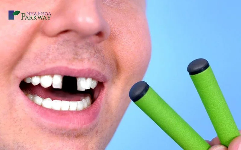 Tại sao nên hồi phục răng bị mẻ