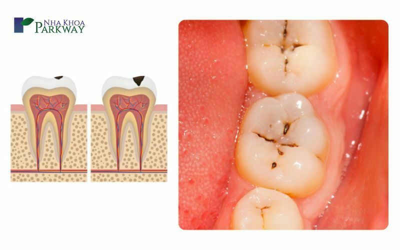 Dấu hiệu nhận biết răng bị sâu đen