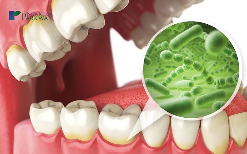 Nguyên nhân răng bị sâu là gì?