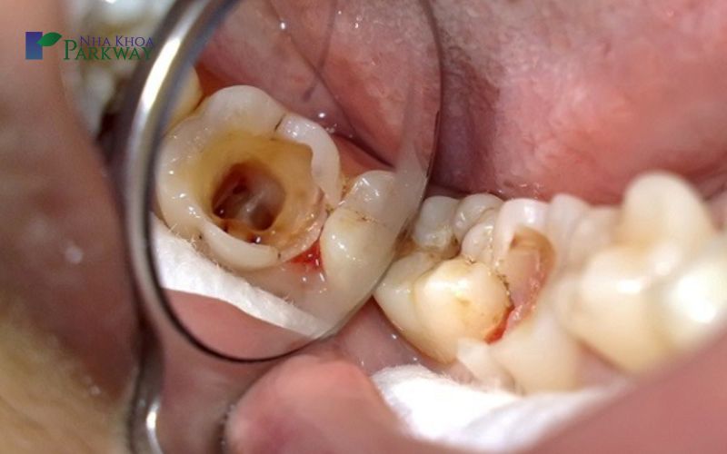 Răng sâu lỗ to là gì?