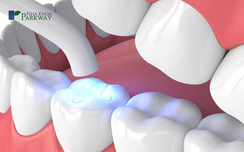 Phương pháp trám răng duy trì được bao lâu?