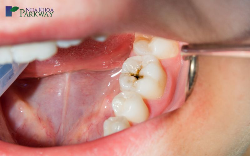 Quy trình hàn răng sâu và lưu ý sau khi hàn răng răng sâu