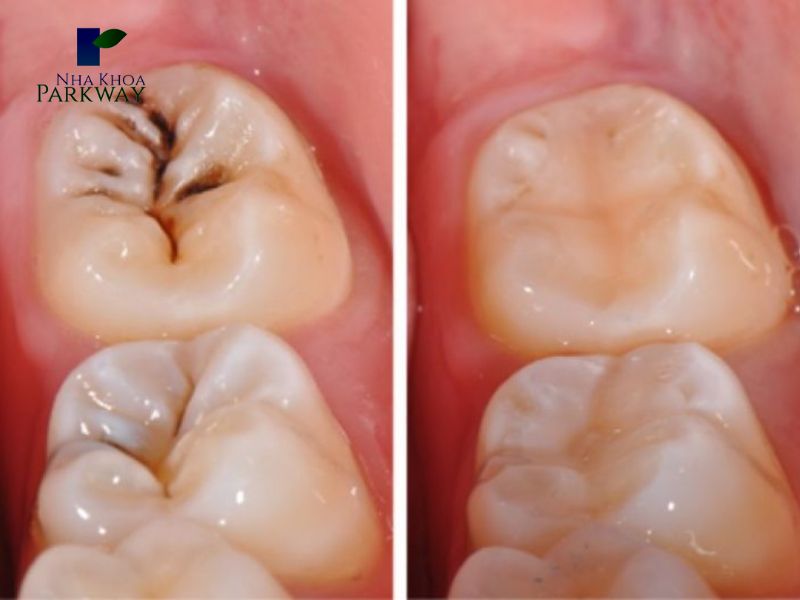 Hình ảnh sâu răng sau khi điều trị sâu răng tận gốc