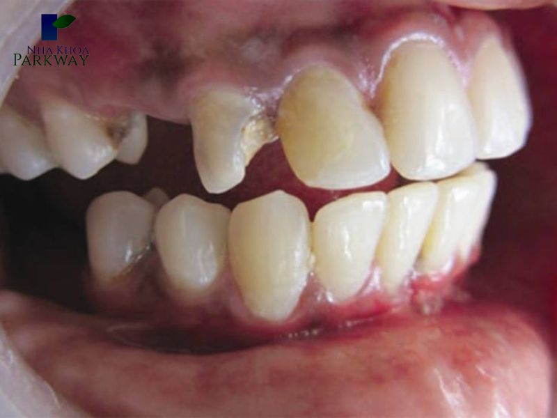 Những hình ảnh sâu răng theo vị trí bị sâu răng