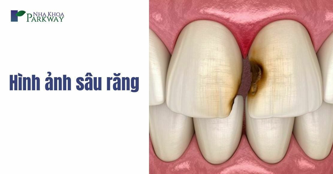 Trồng răng sứ cao cấp hơn trồng răng sứ thường ở điểm gì?