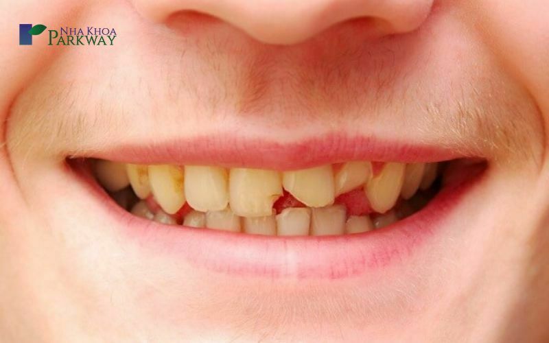 Răng bị mẻ là gì?