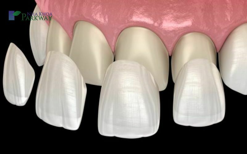 Cách chữa răng bị mẻ tại nha khoa