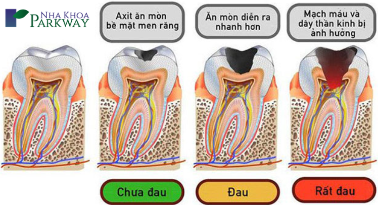 Tổng quan về răng sâu
