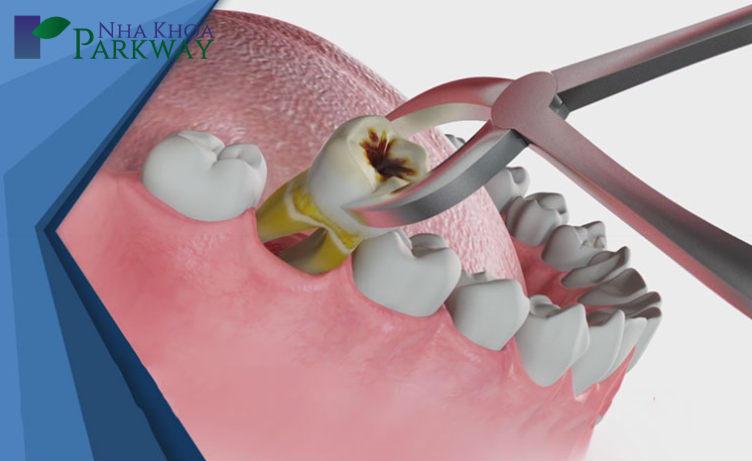 Các bước nhổ răng sâu tại nha khoa