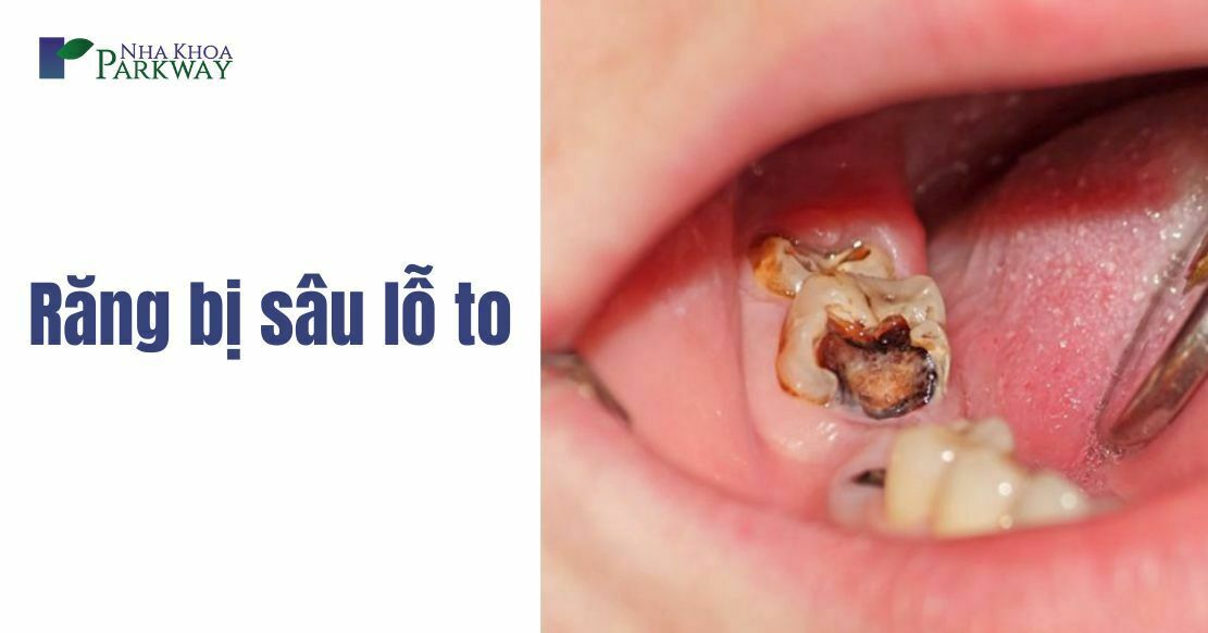 Răng bị sâu lỗ to phải làm sao? Cách ngăn ngừa