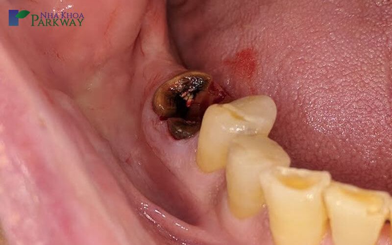 Trường hợp răng sâu bị vỡ chỉ còn chân răng