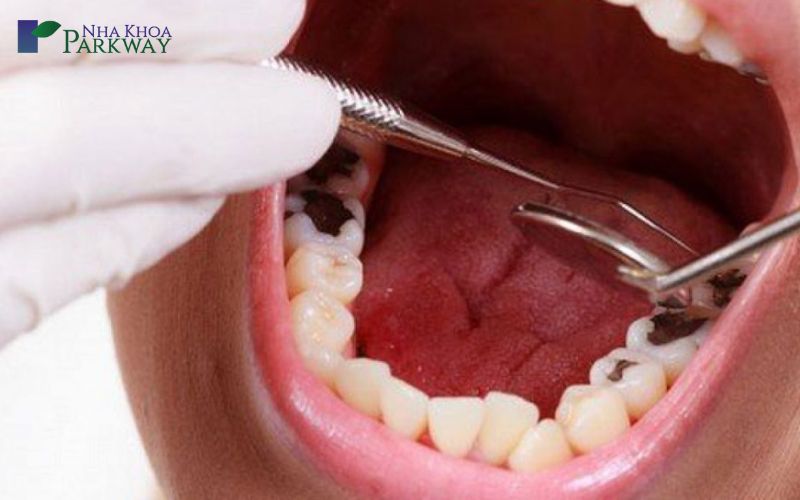 Răng bị sâu chỉ còn chân răng nên làm gì?