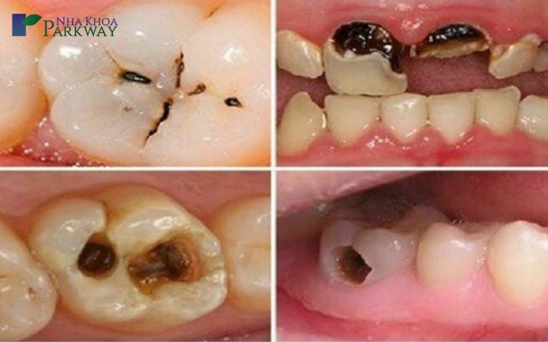 Răng sâu bị vỡ chỉ còn chân răng phải làm sao?