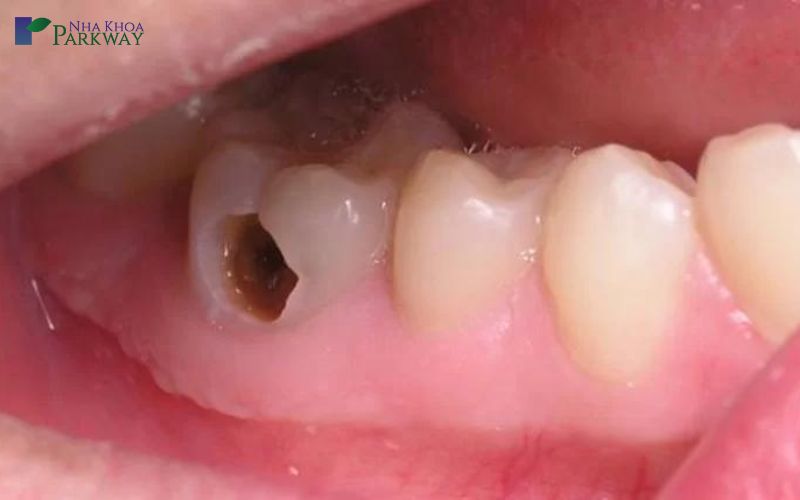 Nguyên nhân răng bị sâu lỗ to là gì?