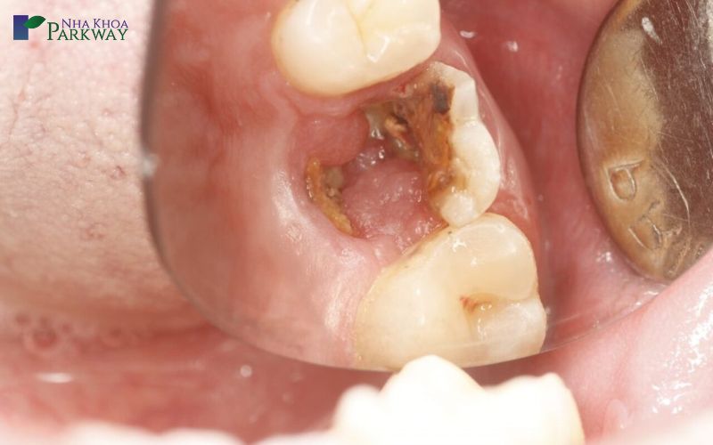 Biến chứng do răng bị sâu lỗ to gây ra