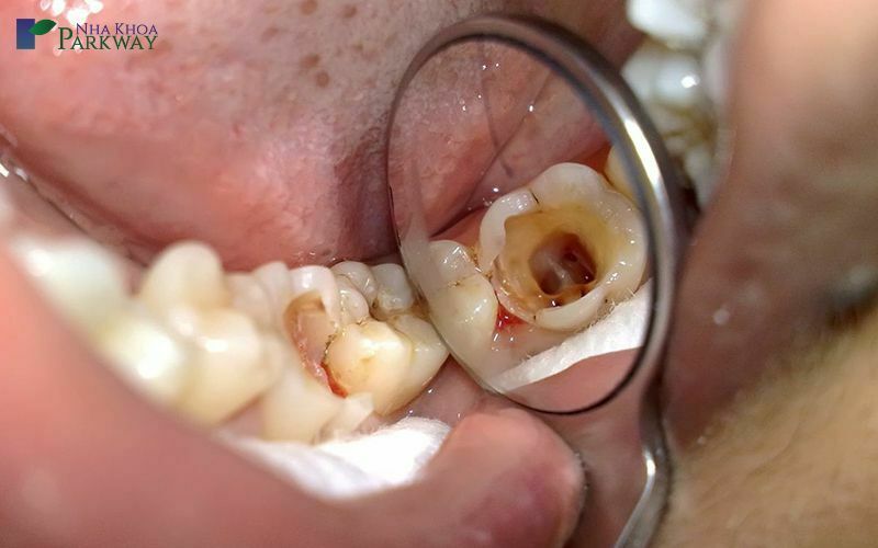 Biến chứng do răng bị sâu lỗ to gây ra