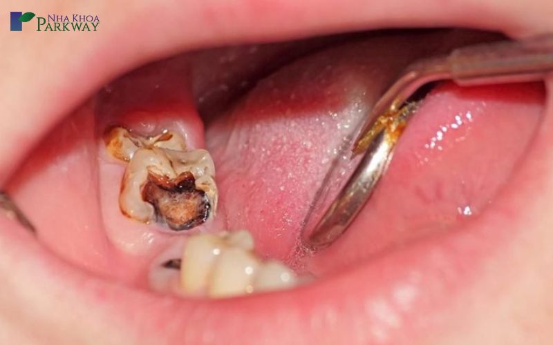 Cách ngăn ngừa tình trạng sâu răng để không phải bị răng bị sâu lỗ to