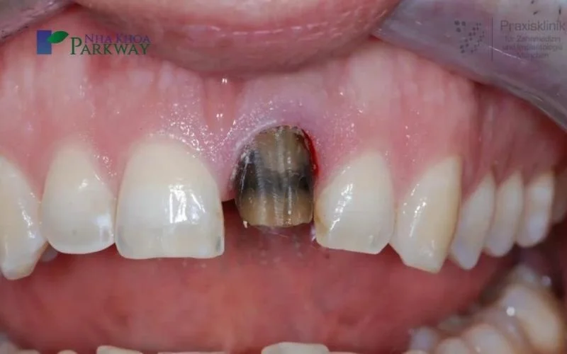 Nguyên nhân gây răng cửa bị sâu bên trong