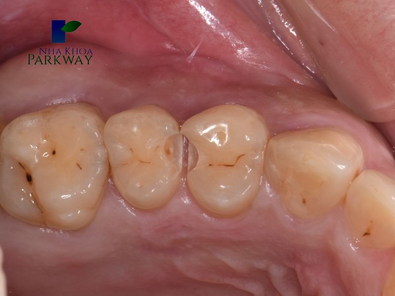 Sâu răng nhẹ và các dạng sâu răng