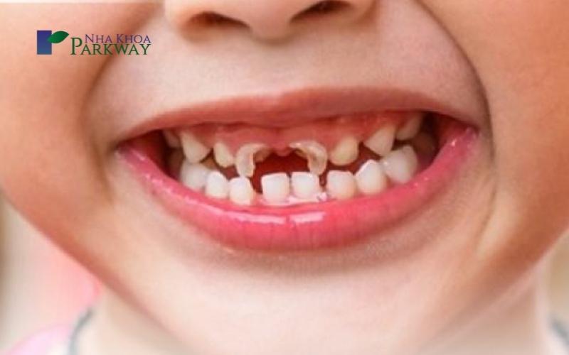 Sâu răng ở trẻ em là gì?