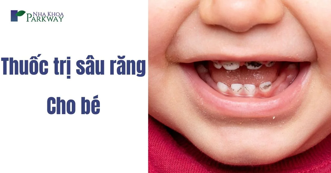 Top 18 thuốc trị sâu răng cho bé hiệu quả, an toàn nhất