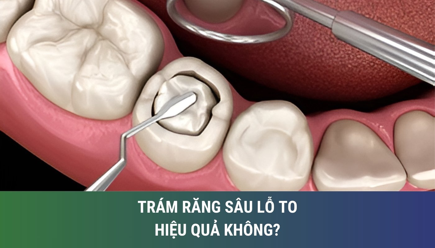 trám răng sâu lỗ to