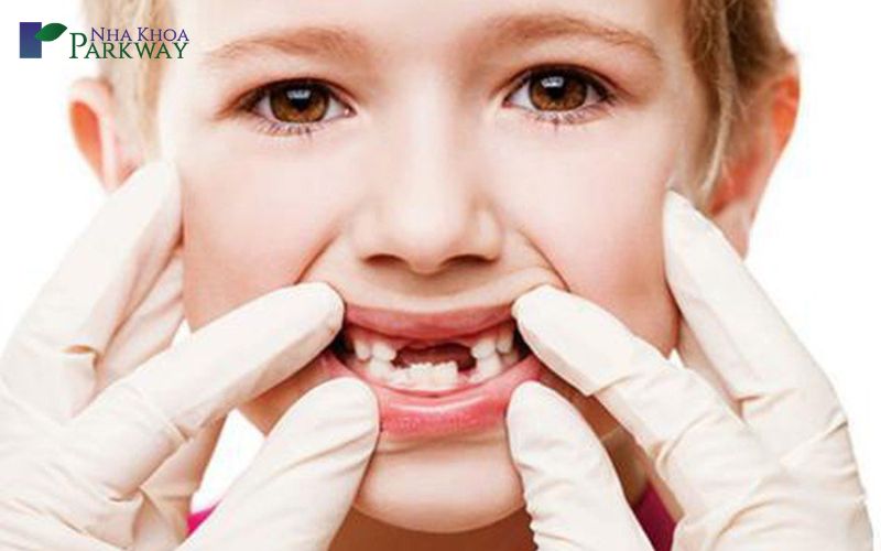 Trẻ 7 tuổi bị sâu răng hàm phải làm sao?