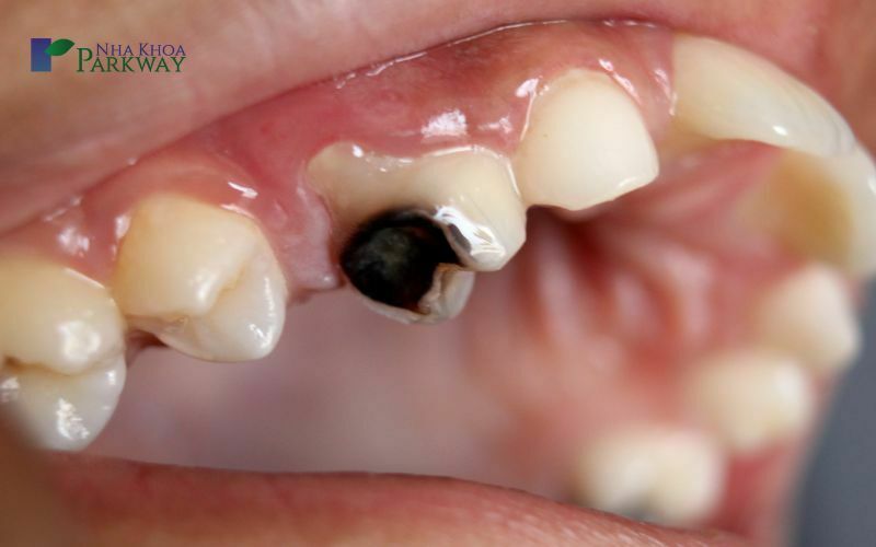 Con sâu răng là gì?