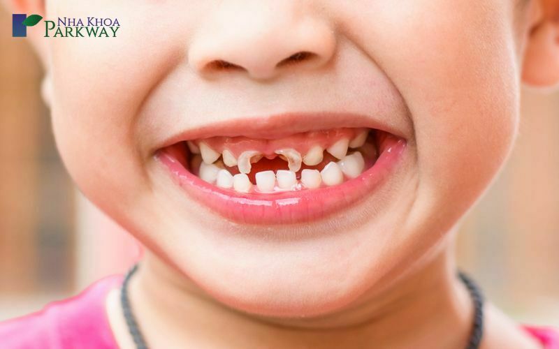 18 Cách chữa đau răng cho trẻ 1 tuổi 2 tuổi 3 tuổi 4 tuổi