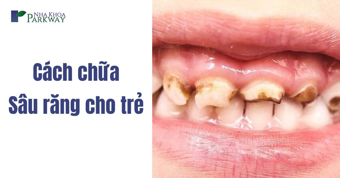 18 Cách chữa sâu răng cho trẻ 1 tuổi 2 tuổi 3 tuổi 4 tuổi