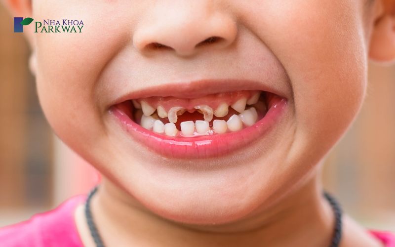 Cách chữa sâu răng cho trẻ 4 tuổi một cách triệt để
