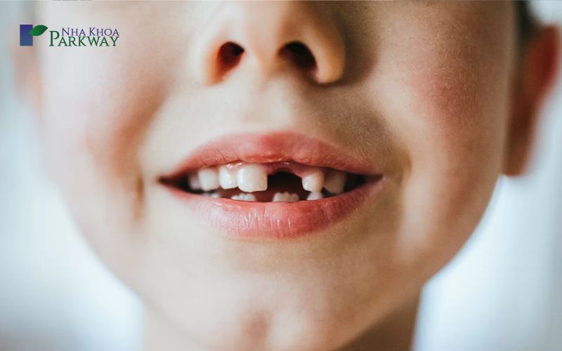 Bé 4 tuổi bị sâu răng hàm phải làm sao tại nhà