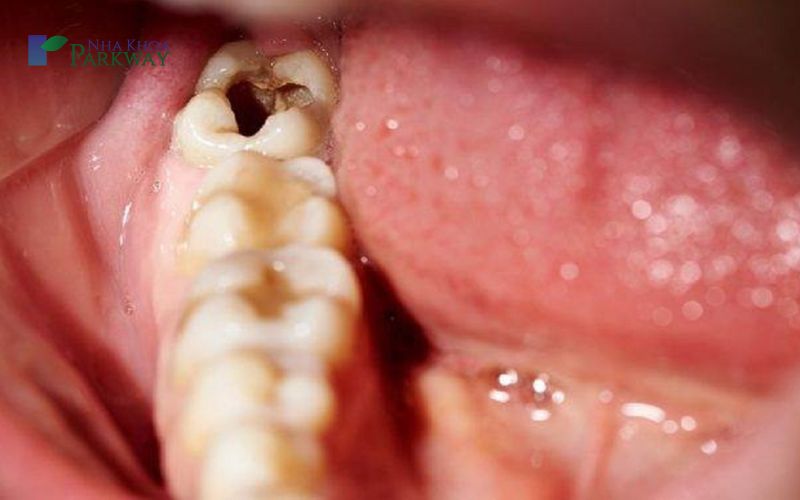 Những yếu tố quyết định chữa sâu răng hàm giá bao nhiêu?